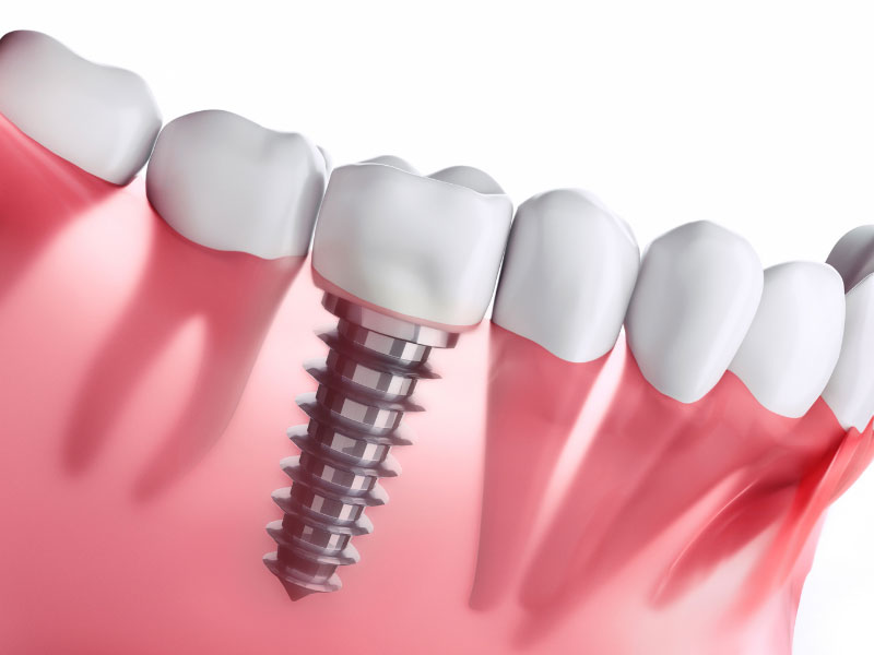 Dental Implants Missing Teeth