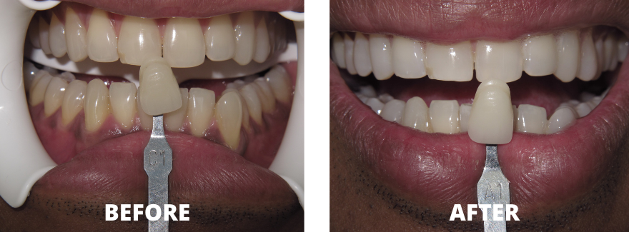 Before & After Treatment